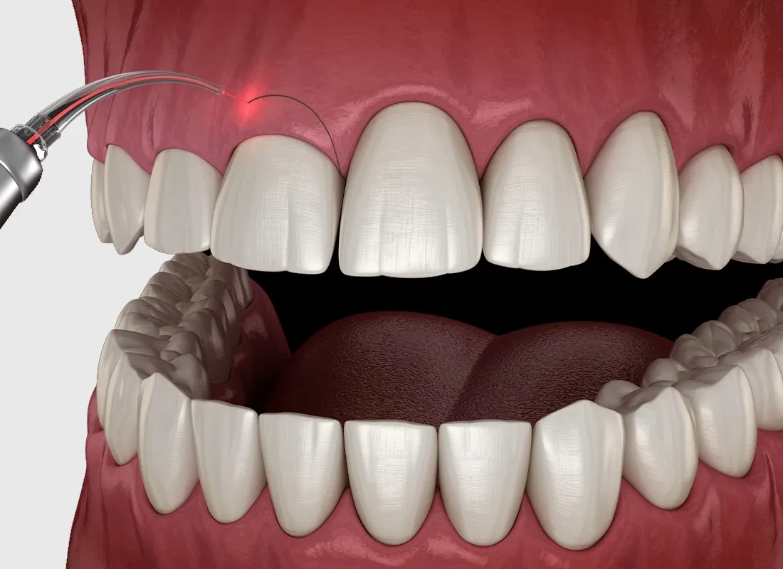 Gum Contouring at Bright Coast Dental