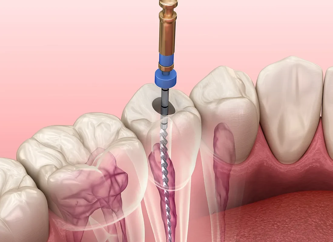 Root Canal at Bright Coast Dental