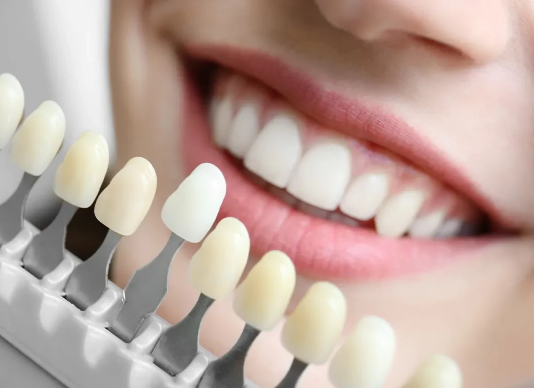 Teeth Whitening at Bright Coast Dental