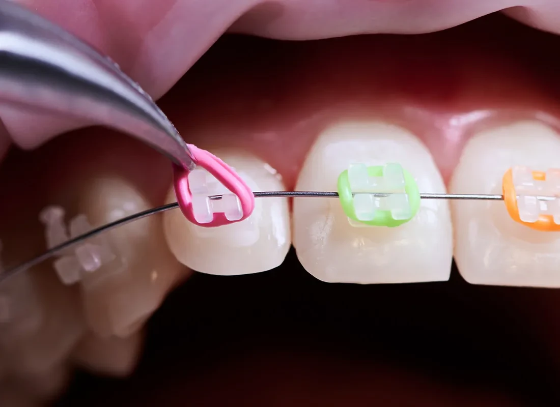 Fastbraces at Bright Coast Dental
