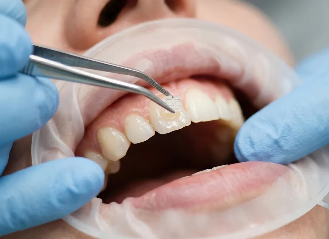 Dental Bonding in Carlsbad, CA