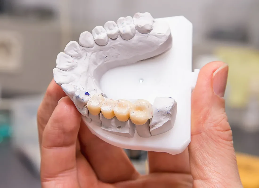 Dental Bridges at Bright Coast Dental