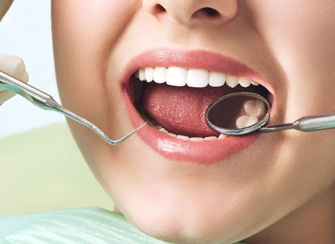Tooth-Colored Fillings in Carlsbad, CA