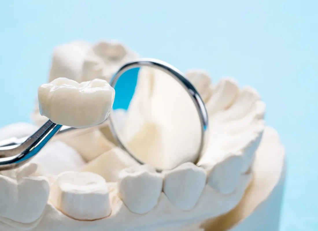 Dental Crowns at Bright Coast Dental