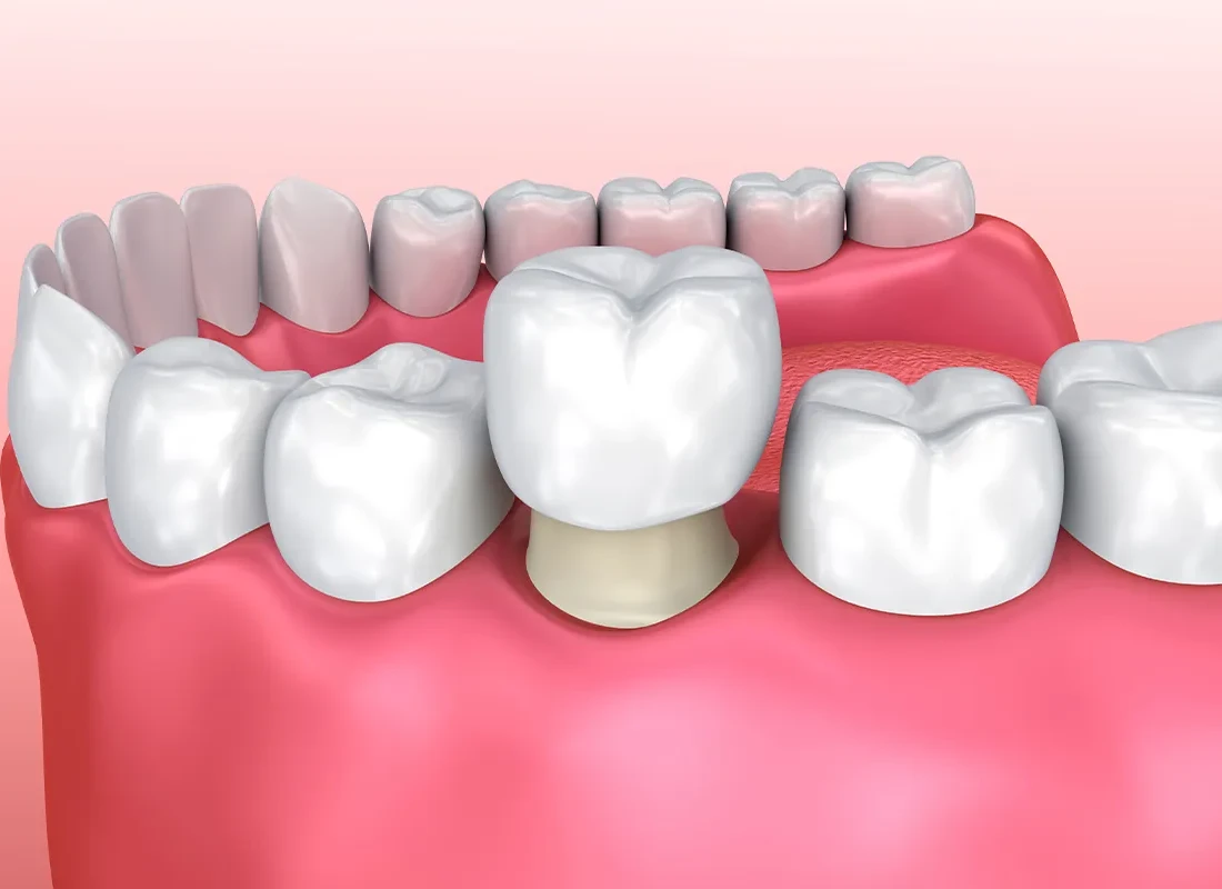 Restorative Dentistry at Bright Coast Dental