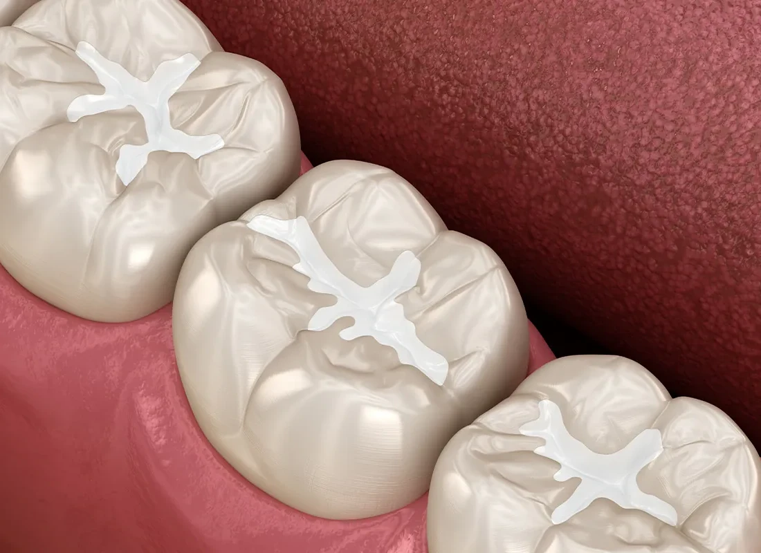 Tooth-Colored Fillings at Bright Coast Dental
