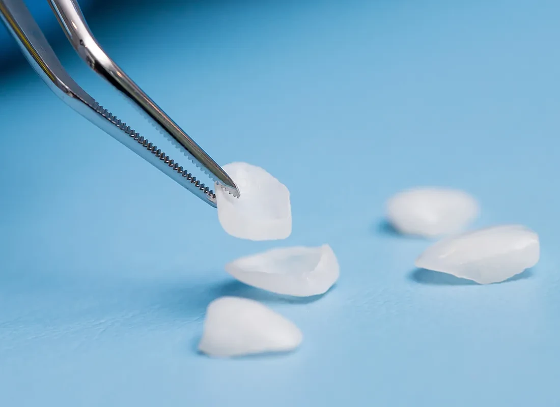 Veneers at Bright Coast Dental