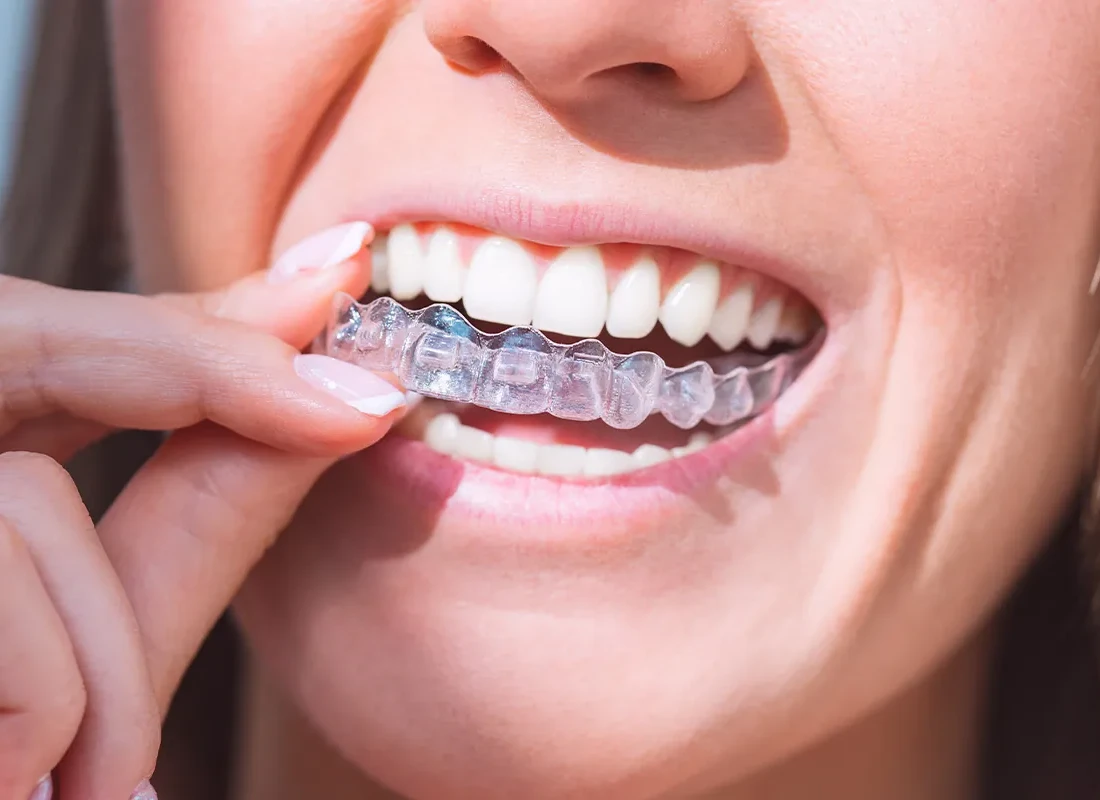 Sports Mouthguards in Carlsbad, CA