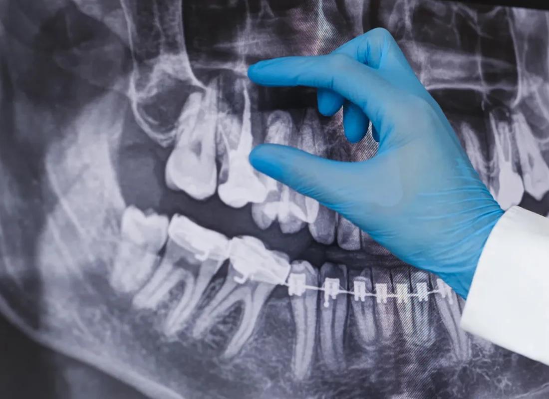 Root Canal at Bright Coast Dental