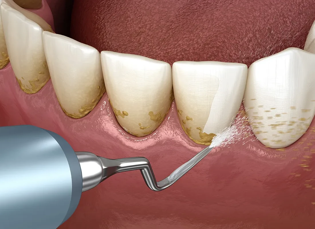 Preventive Dentistry at Bright Coast Dental