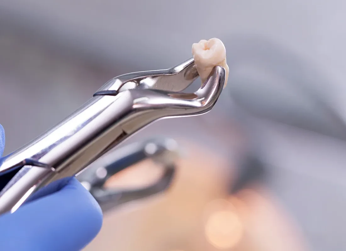 Teeth Extraction at Bright Coast Dental
