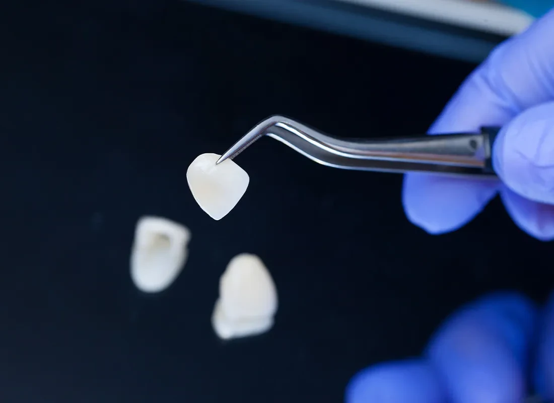 Veneers at Bright Coast Dental