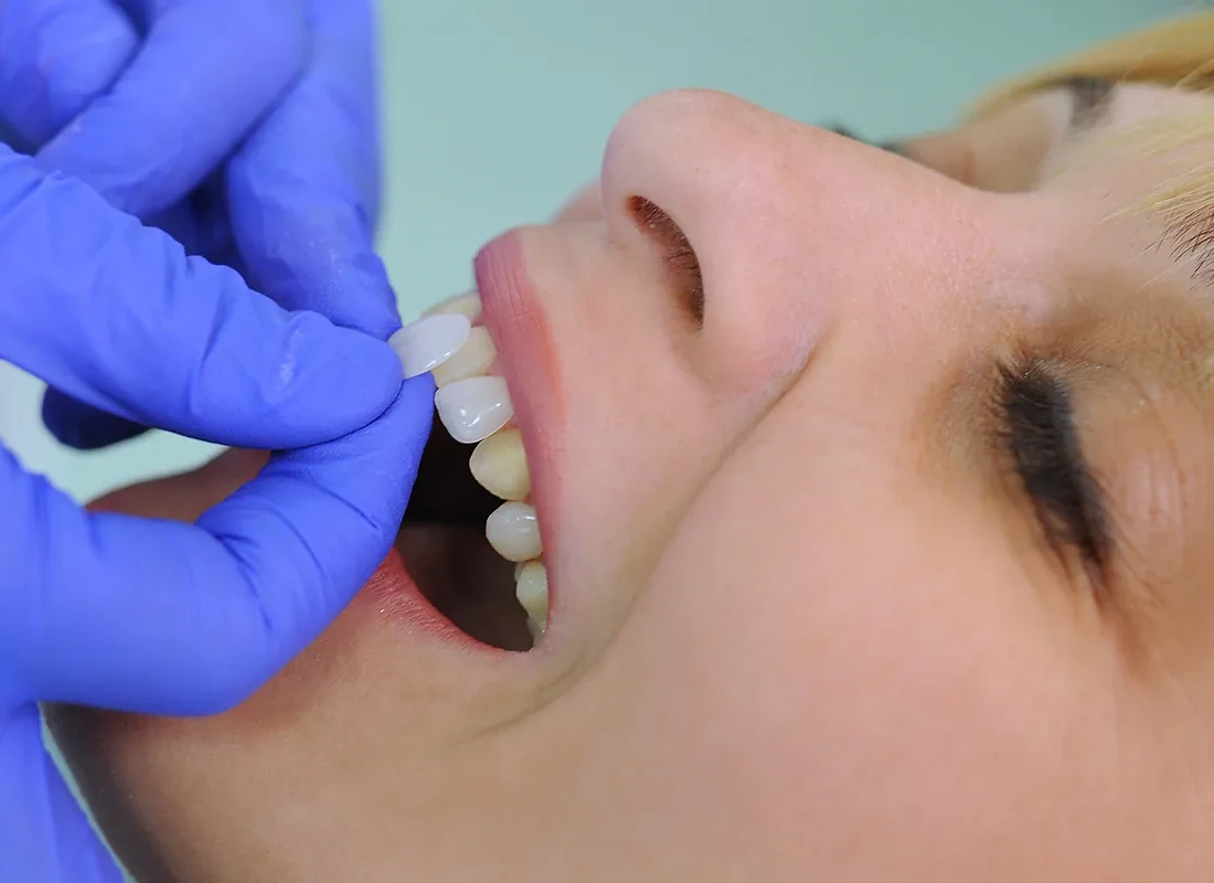 Veneers in Carlsbad, CA