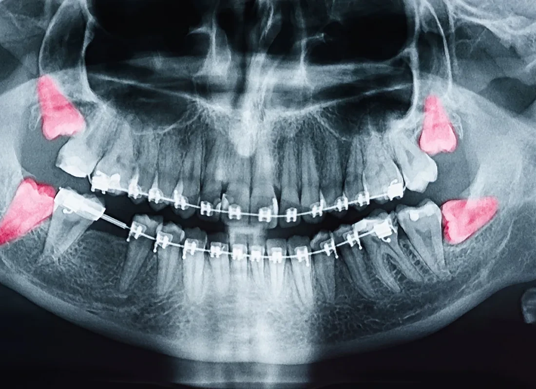 Oral Surgery at Bright Coast Dental
